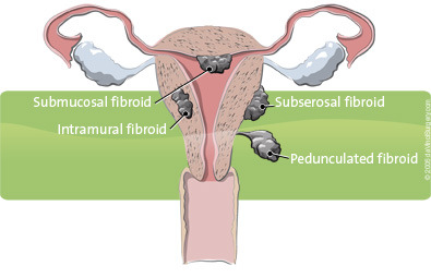 Fibroids img 0