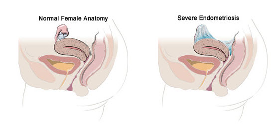 endometriosis1