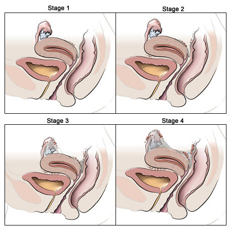 endometriosis2